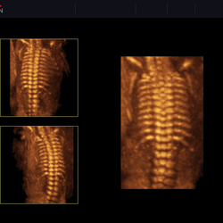 Columna vertebral fetal 3D