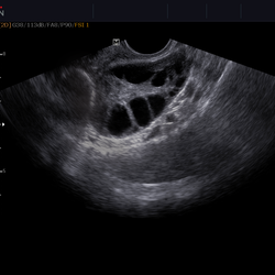 Imagen vaginal de los folículos del ovario