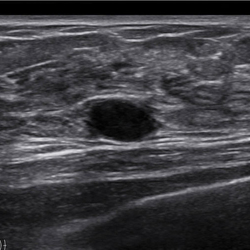Lesión de mama con SDMR