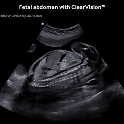 Abdomen fetal con ClearVisionTM