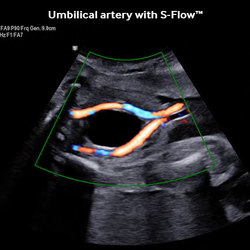 Arteria umbilical con S-FlowTM