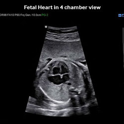Corazón Fetal