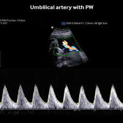 Arteria umbilical con PW