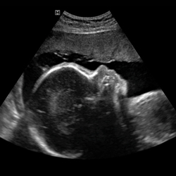 Perfil fetal a las 22 semanas